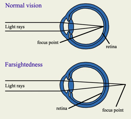 Lasik Surgery For Farsighted People