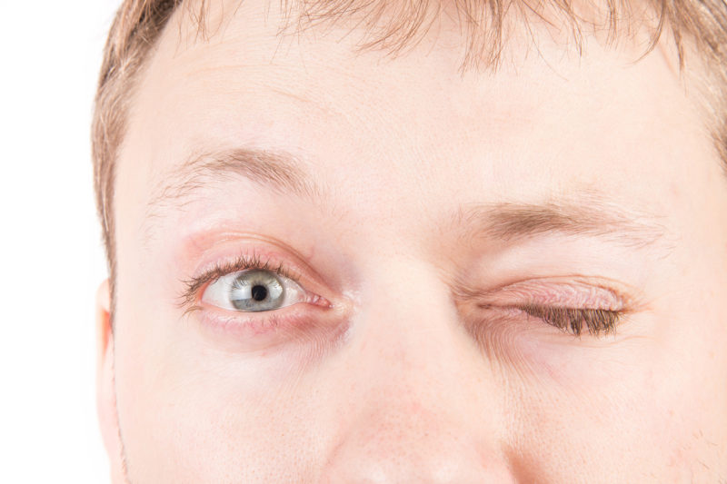 Blink During Eye Surgery