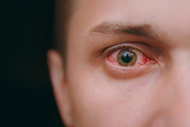 What should I do if I have pink eye?