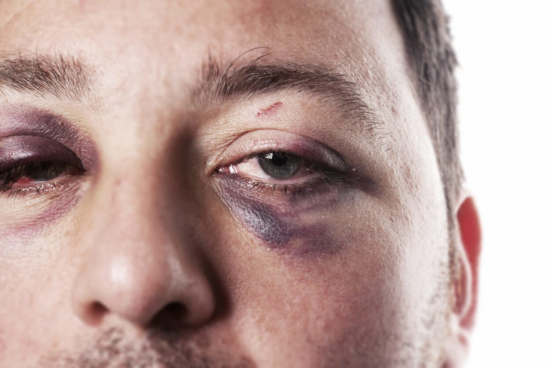 Black Eye: What Causes Black Eyes and How to Get Rid of Them