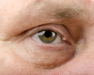 Epidermal cyst on right upper eyelid of middle aged man. Horizontal close up shot.