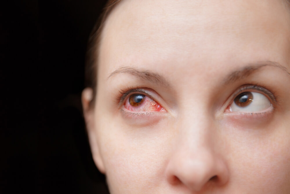 Pinkeye During Pregnancy - What to do