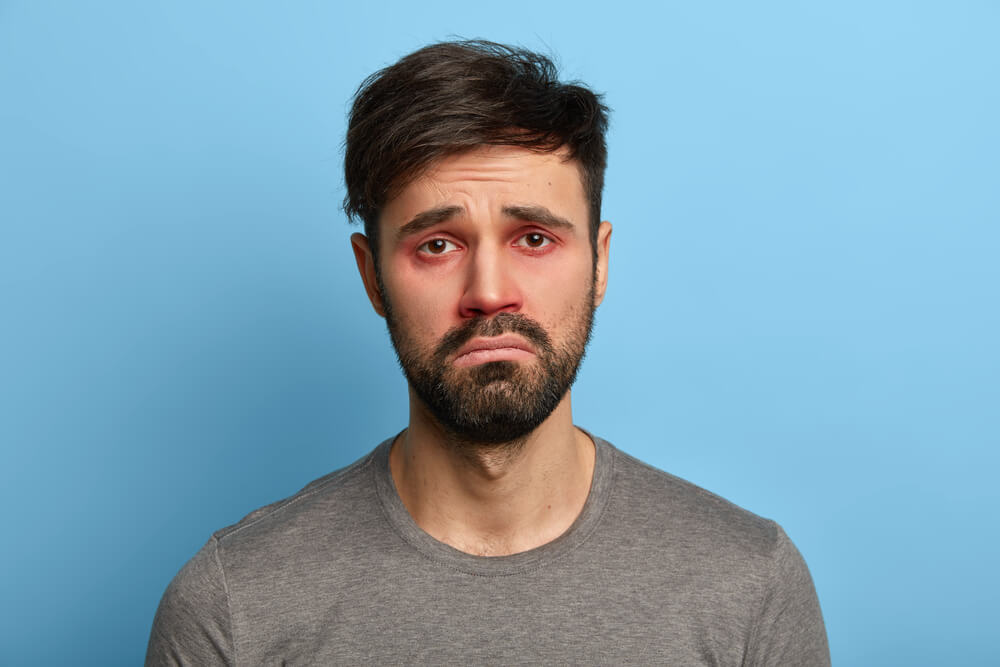 Miserable Displeased Man Has Sick Look, Red Swollen Eyes, Smirks Face, Suffers From Conjunctivitis, Seasonal Allergy, Poses Against Blue Background.