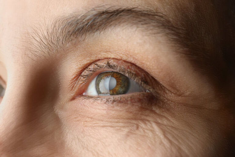 Closeup View of Mature Woman With Cataract